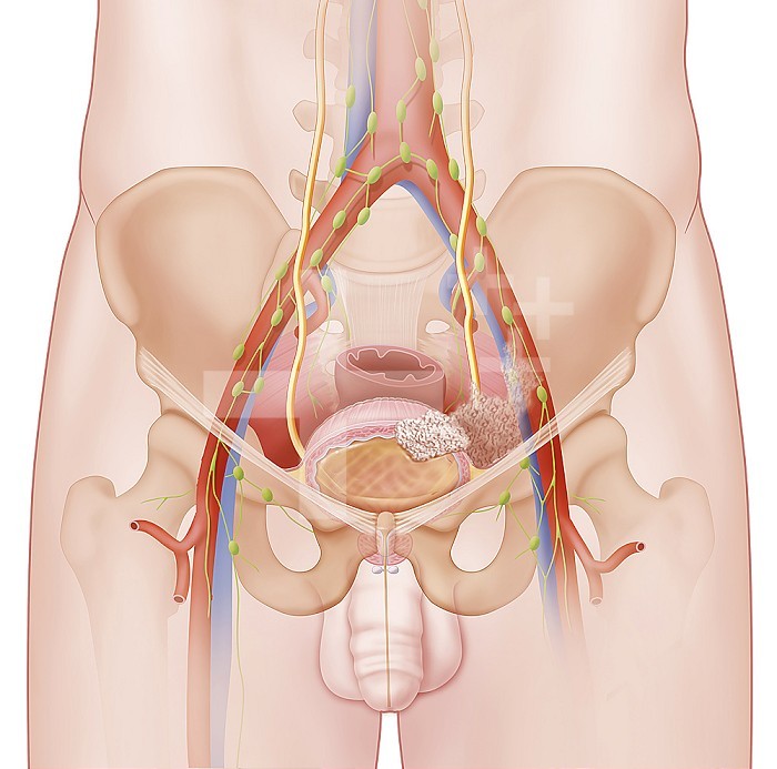 Stage IV bladder cancer, tumor invasion, metastases. This medical illustration represents stage IV bladder cancer (primary cancer). The bladder is shown in section in the pelvic cavity to show the extent of tumor invasion. The tumor invaded the entire wall of the bladder and spread inside and beyond outside into the pelvic cavity. The vessels are affected, as well as the lymphatic system. Metastases can then at this stage migrate via the arterial system to other organs. They will then become dormant metastases and may cause secondary cancers. - Restriction : Exclusive to pharmaceutical laboratories in Belgium. from 04/26/2020