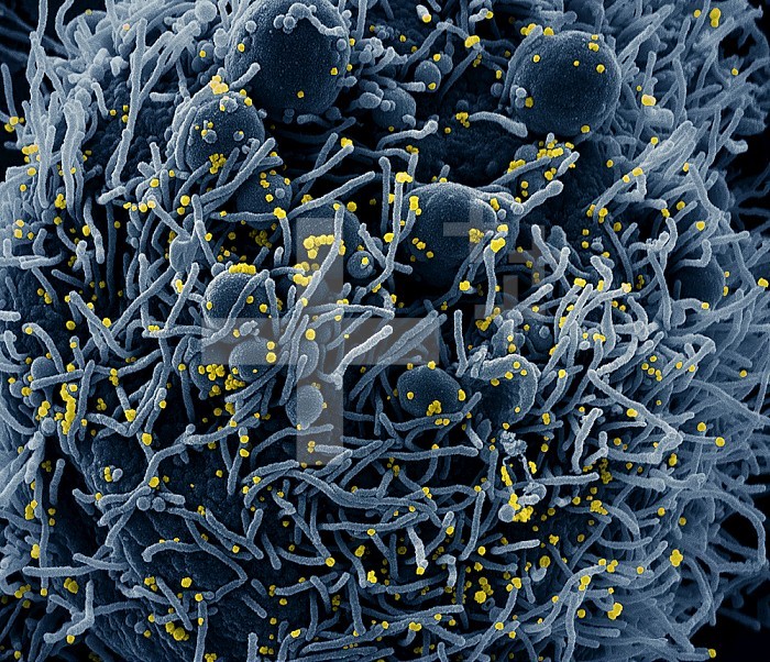 Colorized scanning electron micrograph of an apoptotic cell (blue) infected with SARS-COV-2 virus particles (yellow), isolated from a patient sample. Image captured at the NIAID Integrated Research Facility (IRF) in Fort Detrick, Maryland. Credit: NIAID.