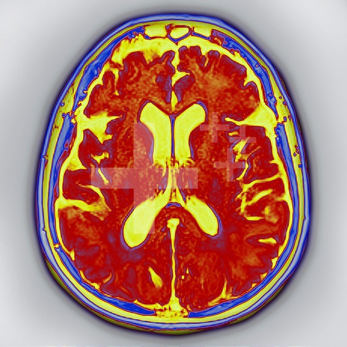 Cerebral atrophy - Bilateral cortical and subcortical temporal atrophy (frontotemporal degeneration responsible for neurodegenerative diseases including Alzheimer´s disease, Lewy body disease, cognitive disorders, and attention disorders. Radial section of the brain , visualized by an MRI in radial section.