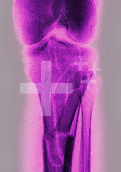 Knee fracture (caused by a violent shock, causing trauma with serious lesions to the tibial plateau and to the lower end of the femur. X-ray of the left knee from the front.