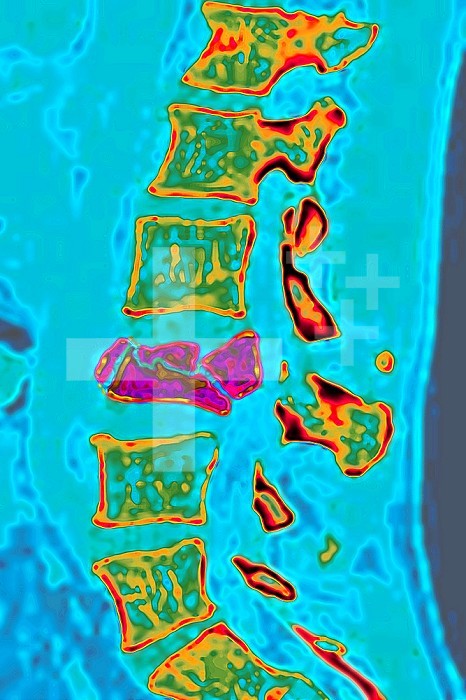 Spontaneous vertebral fracture due to oteoporosis (bone disease characterized by a decrease in bone mass, as well as bone deformation by compression and the risk of spontaneous fracture.). Lumbar vertebral x-ray.