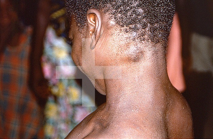 This historic 1997 image was created during an investigation into an outbreak of monkeypox, which took place in the Democratic Republic of Congo (DRC), from 1996 to 1997, formerly Zaire. Pictured is the head and neck of a young woman with cervical swellings diagnosed as lymphadenopathy, or enlarged lymph nodes, due to an active case of monkeypox. CDC / Brian WJ