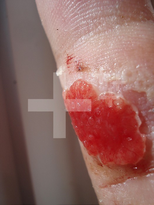 Example of granulation tissue when healing a cut on a finger. Granulation tissue is a highly vascular transient connective tissue, comprising macrophages and fibroplaques.