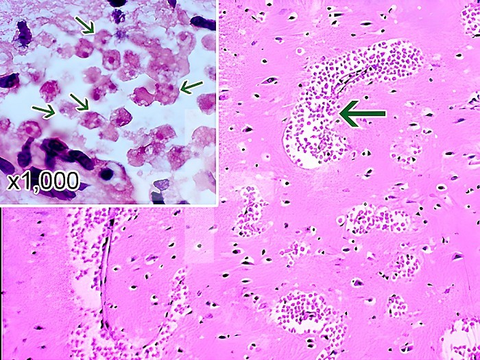 A section of the cerebral portion of the brain of a patient with primary amoebic meningoencephalitis, stained with hematoxylin and eosin, showing large clumps of Naegleria fowleri trophozoites and destruction of normal tissue architecture cerebral. The cysts are not visible. Magnification: 100x. Inset: Higher magnification (1000x) of Naegleria fowleri trophozoites (arrows) with characteristic nuclear morphology.