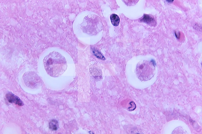 Under a magnification of 1180X, this 1973 hematoxylin-eosin (HE)-stained photomicrograph revealed the histopathology found in a case of primary amoebic meningoencephalitis (PAM), due to the presence of free-living, Naegleria gruberi , amoebae. CDC/ Dr. George R. Healy 1973