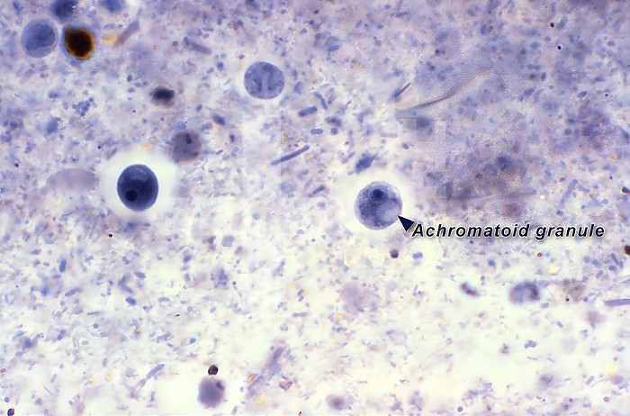 This photomicrograph of an iron-hematoxylin stained specimen revealed the presence of two spheroid parasitic cysts, Iodamoeba butschlii (buetschlii). The cyst on the right contained a clearly visible achromatoid granule in its cytoplasm (arrow). CDC/Dr Mae Melvin 1977