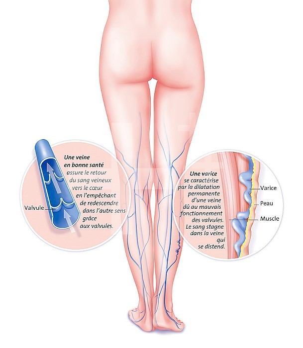 Illustration of a varicose vein. On the left, a healthy vein, with all valves working normally, letting blood return to the heart without blood flowing back the way it came. On the right, a close up of a varicose vein caused by valve malfunctioning. The v